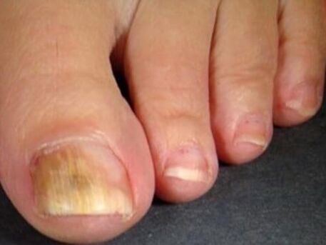 Nagelpilz